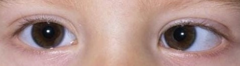 A real esotropia photo from the dataset