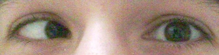 A real esotropia photo from the dataset