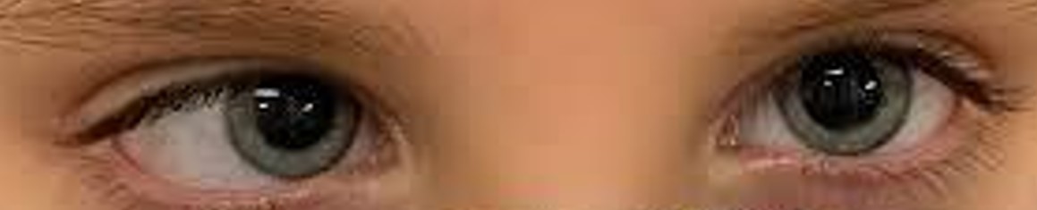 A real esotropia photo from the dataset