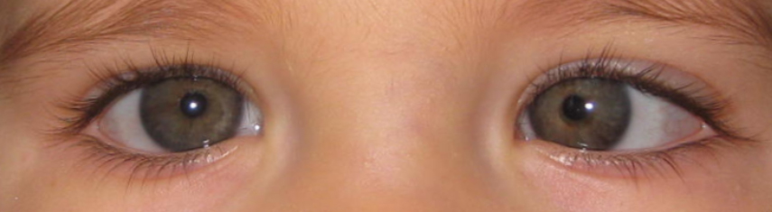 Esotropia example