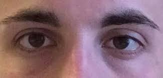 Esotropia example