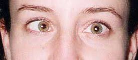 Esotropia example