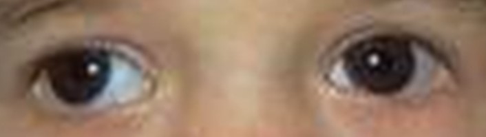 A real exotropia photo from the dataset