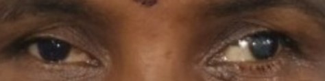 A real exotropia photo from the dataset