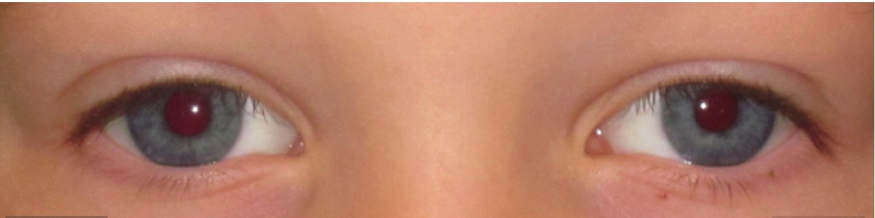 A real exotropia photo from the dataset