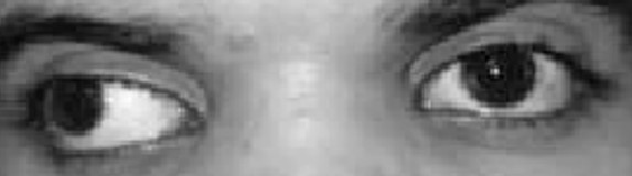 Exotropia example