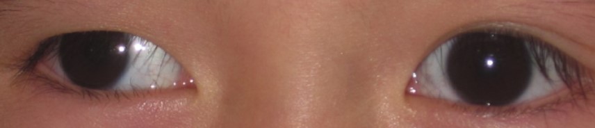 Exotropia example