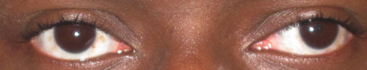 Exotropia example