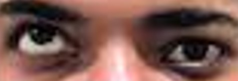 A real hypertropia photo from the dataset