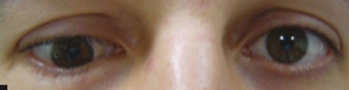 A real hypotropia photo from the dataset