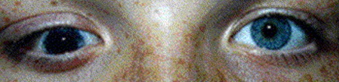 A real hypotropia photo from the dataset