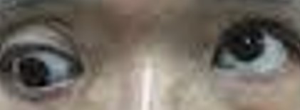 A real hypotropia photo from the dataset