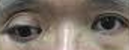 Hypotropia example