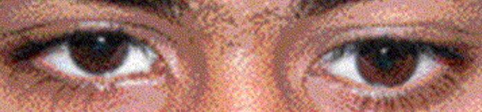 Hypotropia example