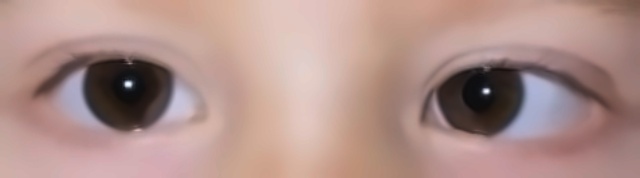 Our esotropia photo, its class